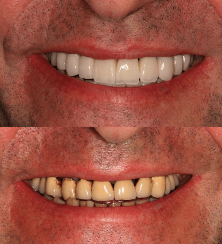 casos-antes-y-despues-odontologia-estetica-coronas-porcelana