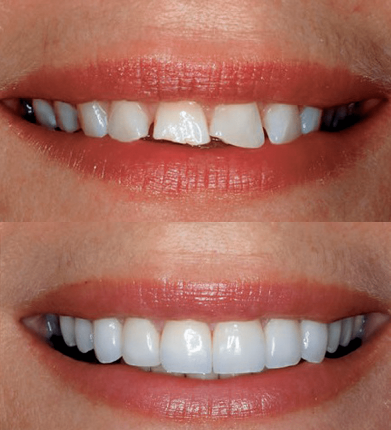 casos-antes-y-despues-odontologia-estetica-coronas-porcelana