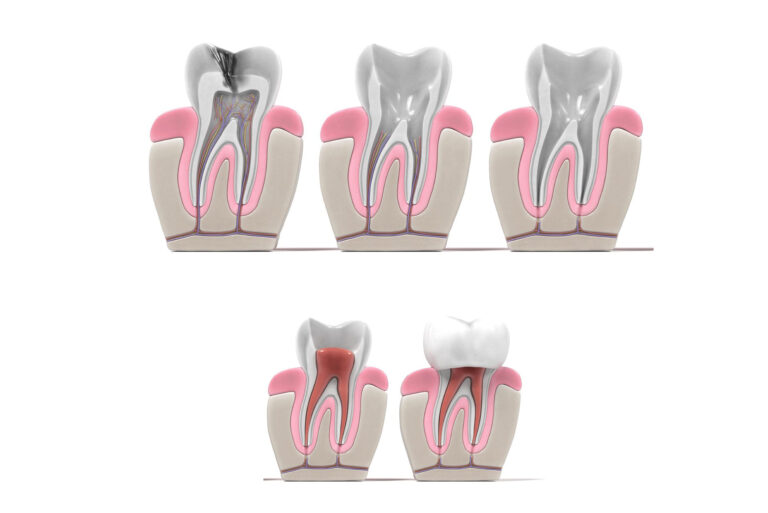 endodoncia en el Prat - Clínica Dental Casaus