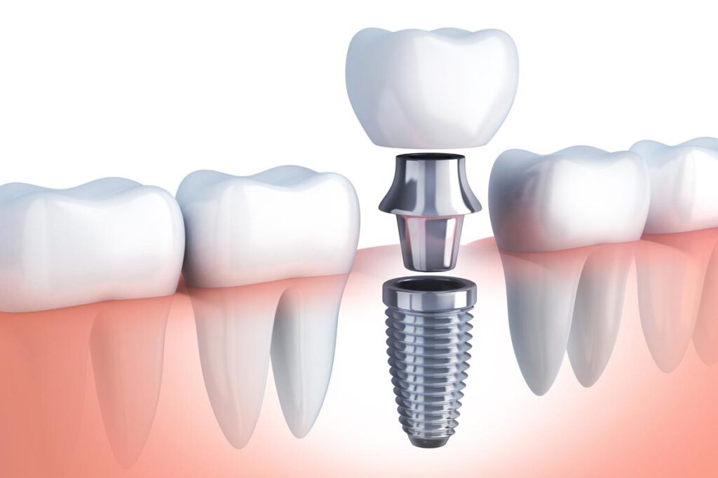 implantes-dentales