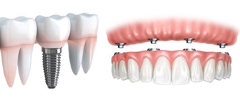 implantes-dentales-el-prat