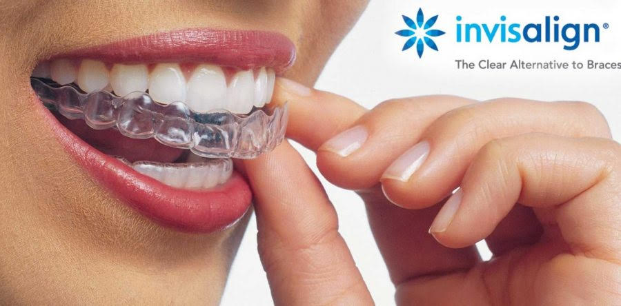 ortodoncia-invisible-invisalign-el-prat