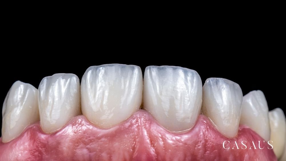 Carillas y coronas dentales en el Prat (Barcelona) Clinica Dental Casaus