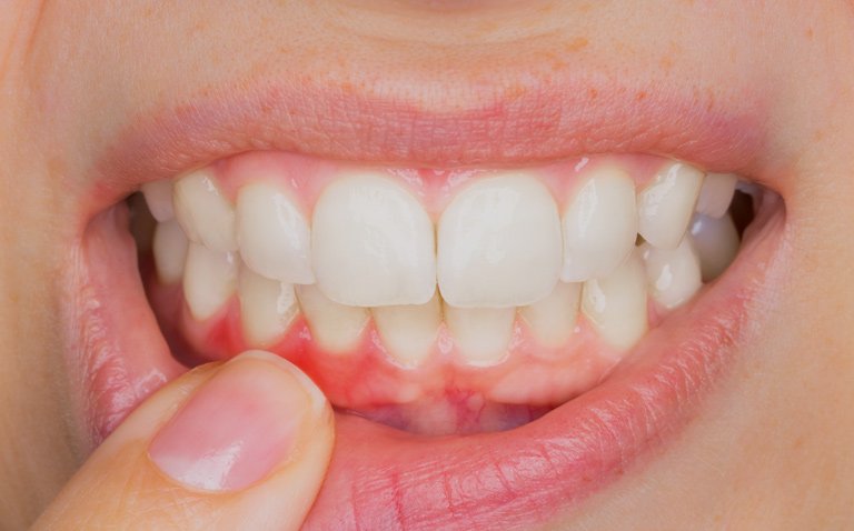 enfermedad-periodontal3