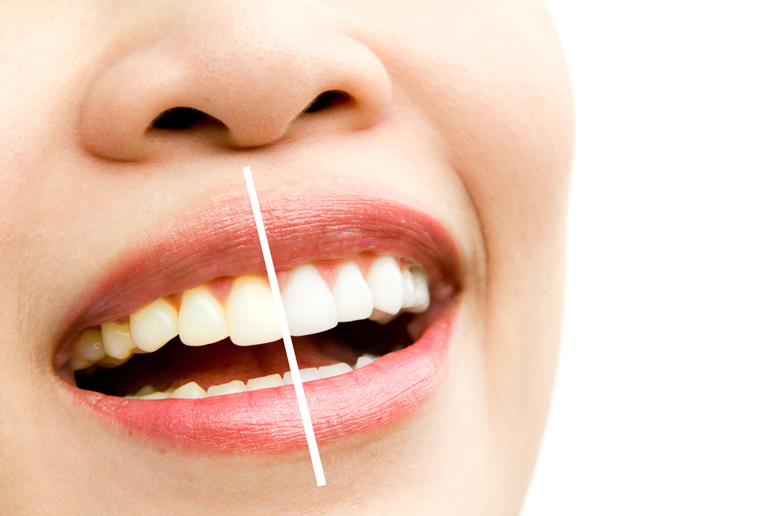 mejorar el color de los dientes - Clínica El Prat