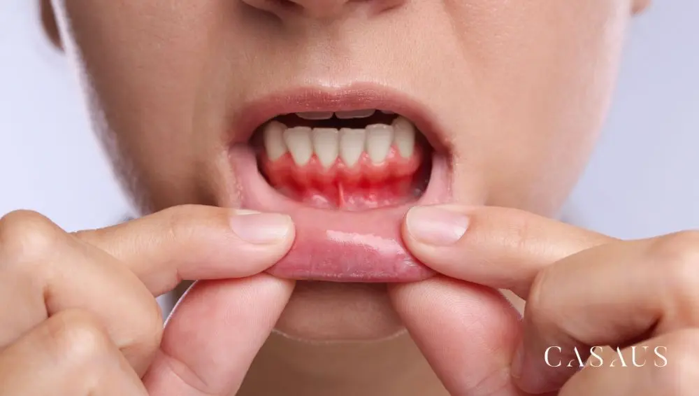 Gingivitis en el Prat (Barceloan) Clinica Dental Casaus