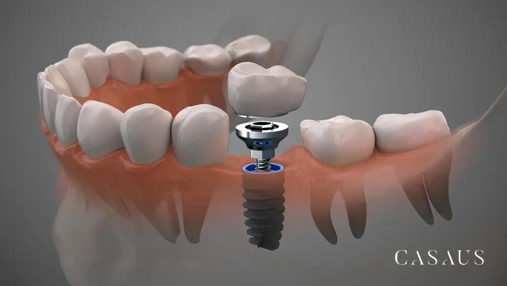 Implantes dentales en el Prat CLinica Dental Casaus