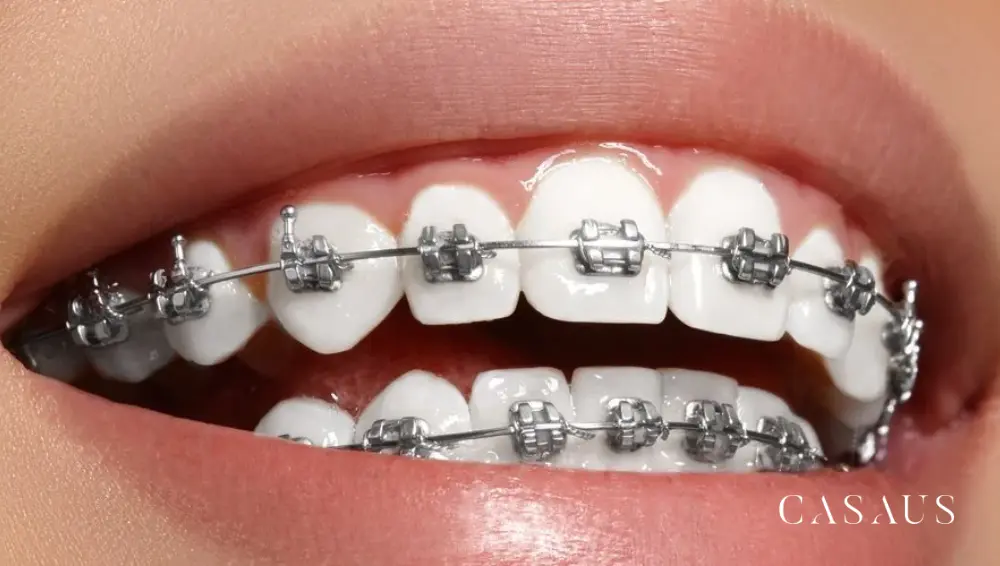 Dientes con brackets después de un tratamiento de ortodoncia