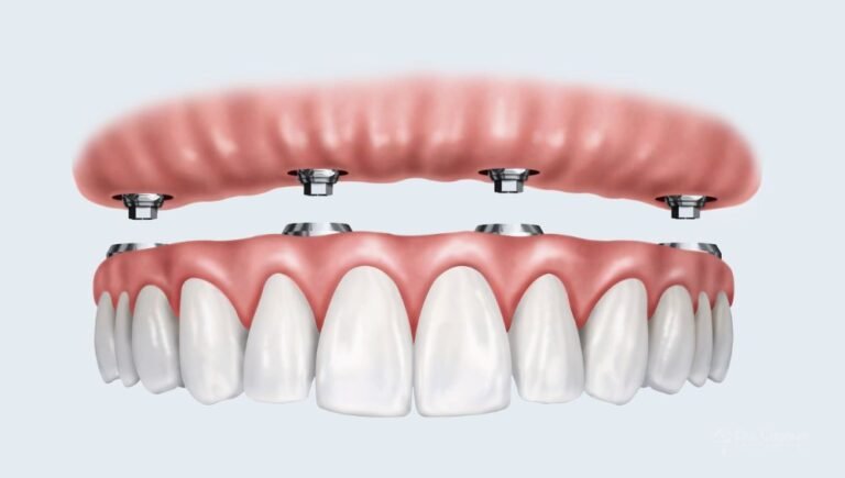 implantes-all-on-four