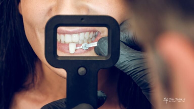 carillas-dentales-sin-tallado-el-prat-barcelona