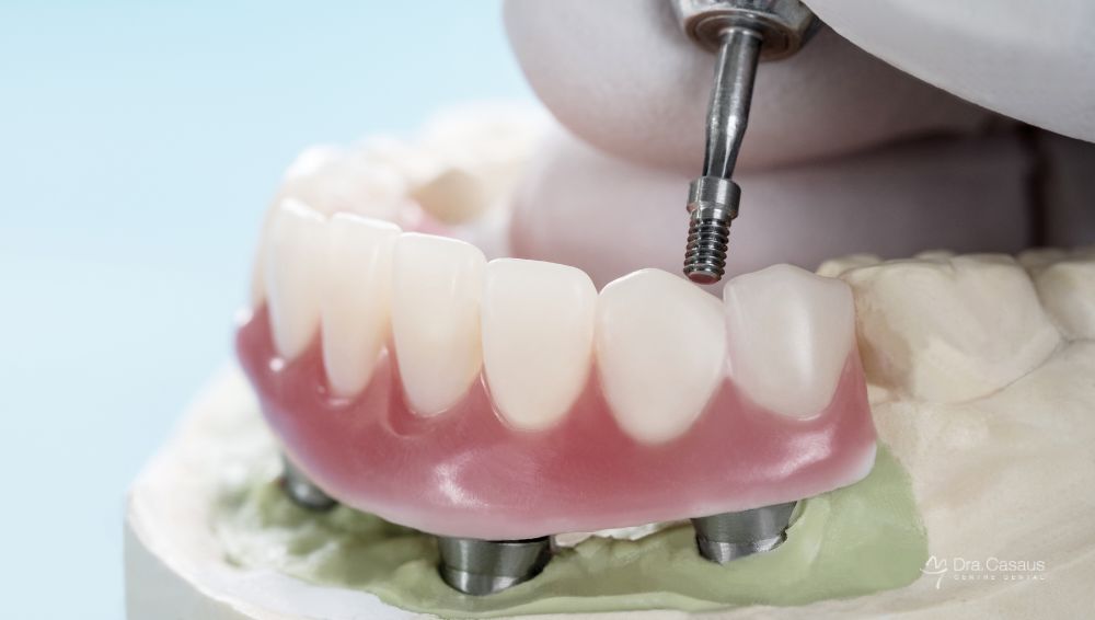 sobredentadura-sobre-implantes-dentales