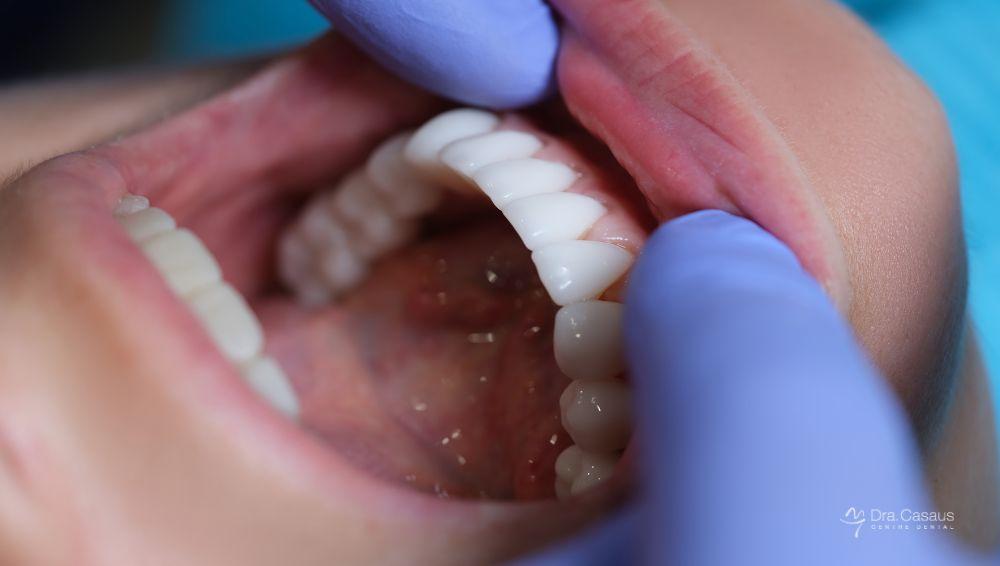 carillas-dentales-cuidado-y-mantenimiento