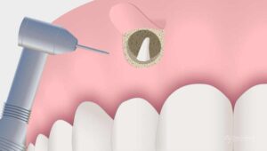 apicectomia-clinica-denta-casaus-llobregat