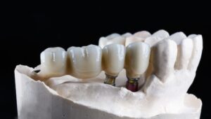 puente-dental-fijo-sobre-implantes