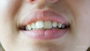 dientes-torcidos-tratamiento-el-prat-dra-casaus