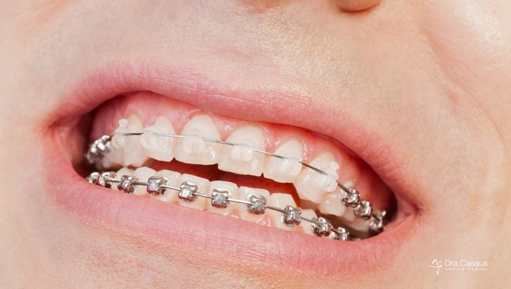 ortodoncia-brackets-tipos