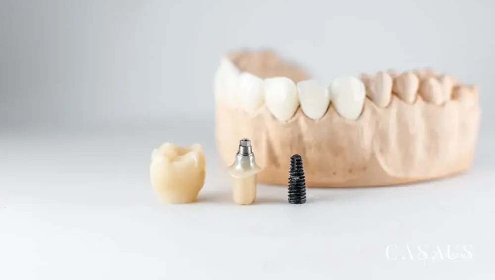 Tipos de implantes dentales actuales