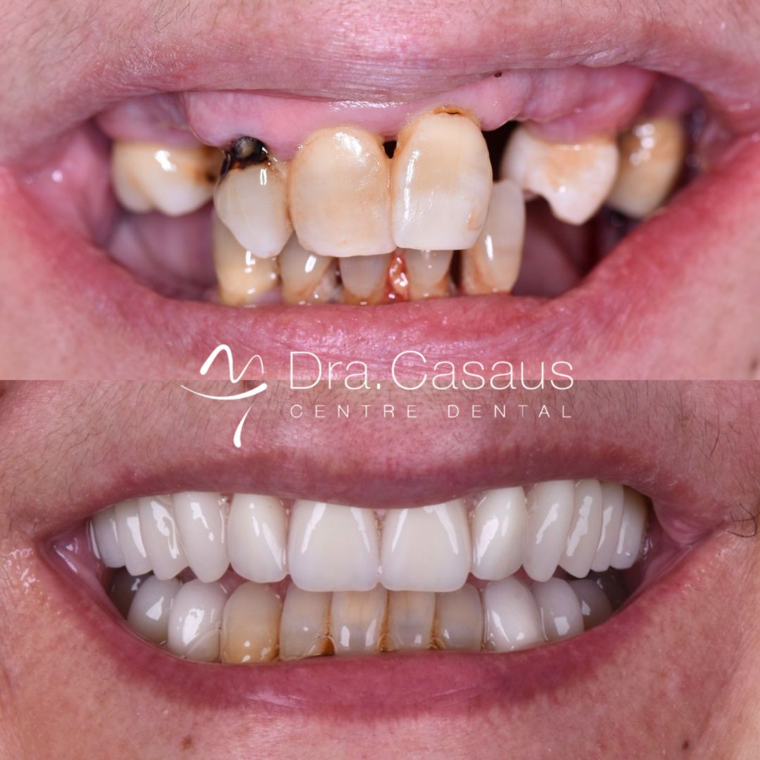 implantes-dentales-estetica-dental-el-prat