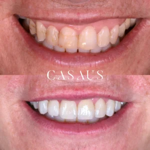 carillas coronas clinica dental casaus el prat de llobregat (1)