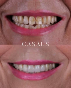 carillas coronas clinica dental casaus el prat de llobregat (10)