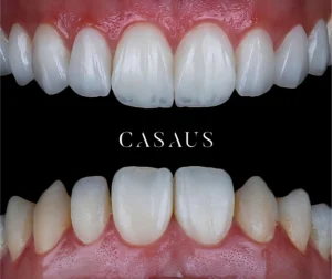carillas coronas clinica dental casaus el prat de llobregat (11)