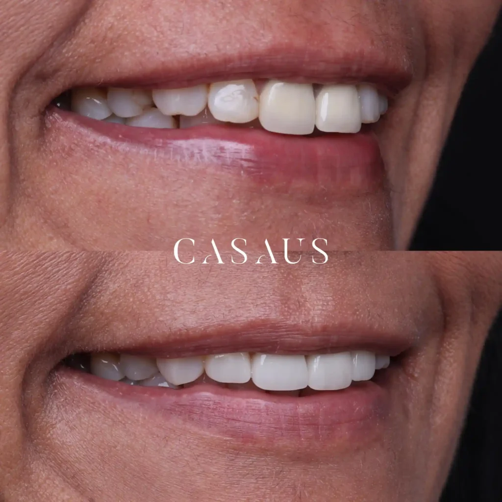 carillas coronas clinica dental casaus el prat de llobregat (13)