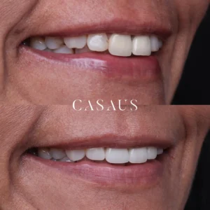 carillas coronas clinica dental casaus el prat de llobregat (13)