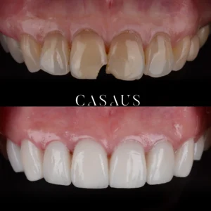 carillas coronas clinica dental casaus el prat de llobregat (14)