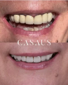 carillas coronas clinica dental casaus el prat de llobregat (2)