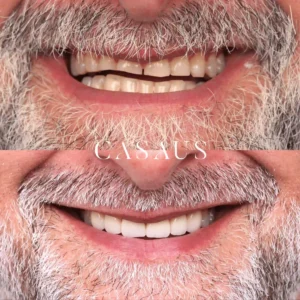 carillas coronas clinica dental casaus el prat de llobregat (4)