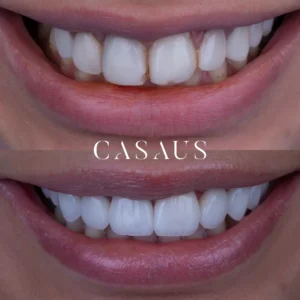 carillas coronas clinica dental casaus el prat de llobregat (5)