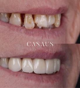 carillas coronas clinica dental casaus el prat de llobregat (6)