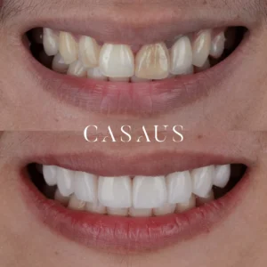 carillas coronas clinica dental casaus el prat de llobregat (7)