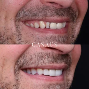 carillas coronas clinica dental casaus el prat de llobregat (8)