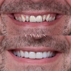 carillas coronas clinica dental casaus el prat de llobregat (9)