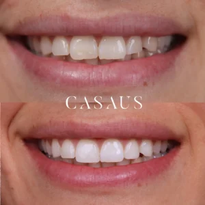 caso blanqueamiento antes despues casaus (1)