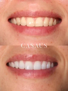 caso blanqueamiento antes despues casaus (2)