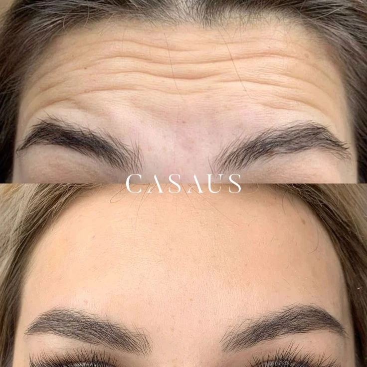 casos antes despues medicina estetica casaus el prat de llobregat (1)