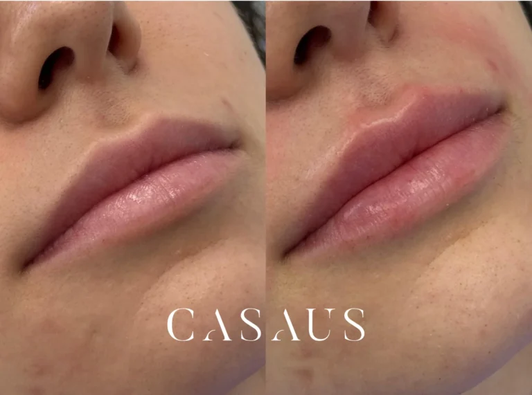 casos antes despues medicina estetica casaus el prat de llobregat (10)