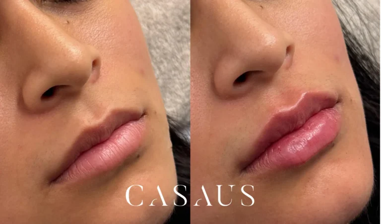 casos antes despues medicina estetica casaus el prat de llobregat (12)