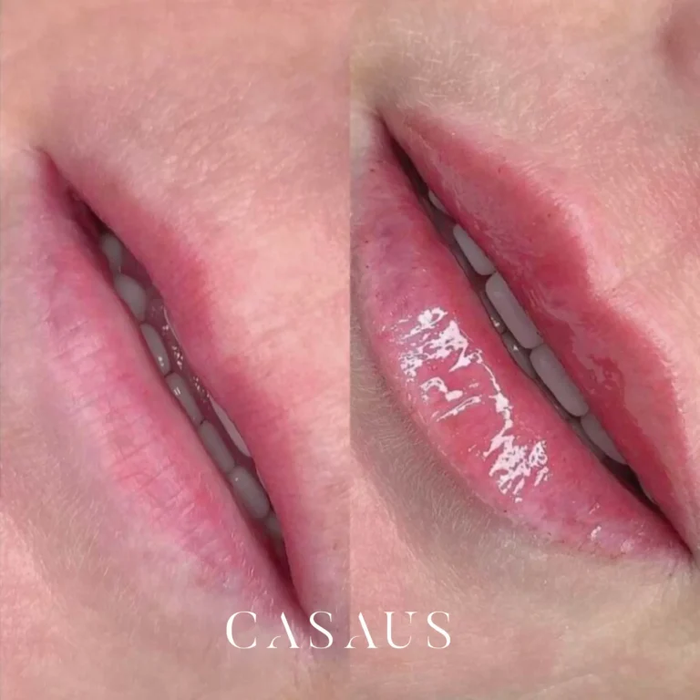 casos antes despues medicina estetica casaus el prat de llobregat (13)