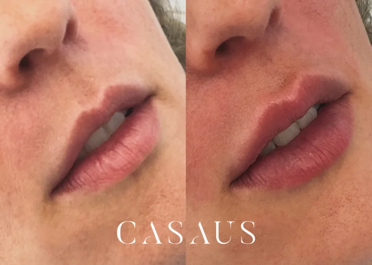 casos antes despues medicina estetica casaus el prat de llobregat (15)