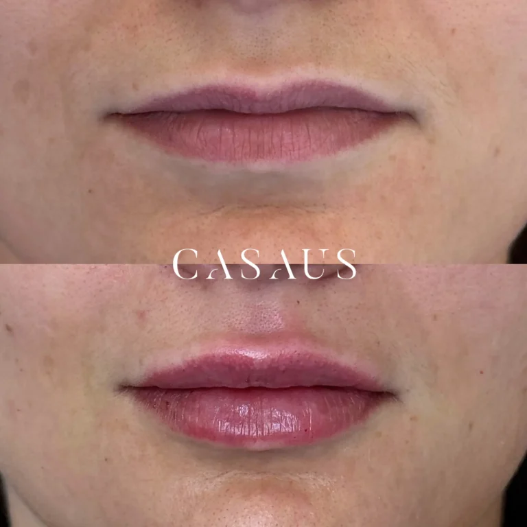 casos antes despues medicina estetica casaus el prat de llobregat (2)