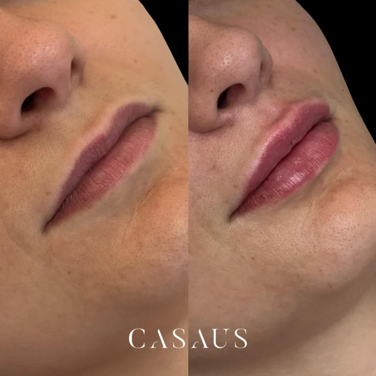 casos antes despues medicina estetica casaus el prat de llobregat (3)