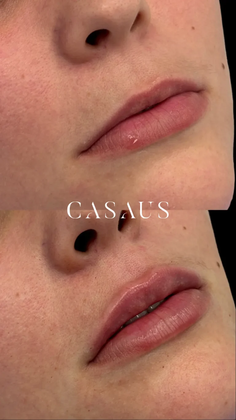 casos antes despues medicina estetica casaus el prat de llobregat (5)