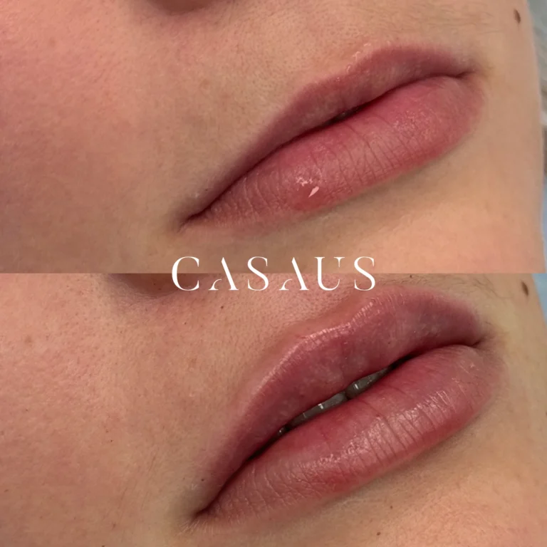 casos antes despues medicina estetica casaus el prat de llobregat (6)