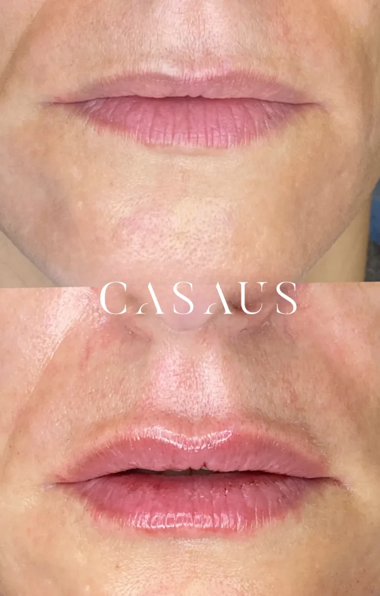 casos antes despues medicina estetica casaus el prat de llobregat (7)