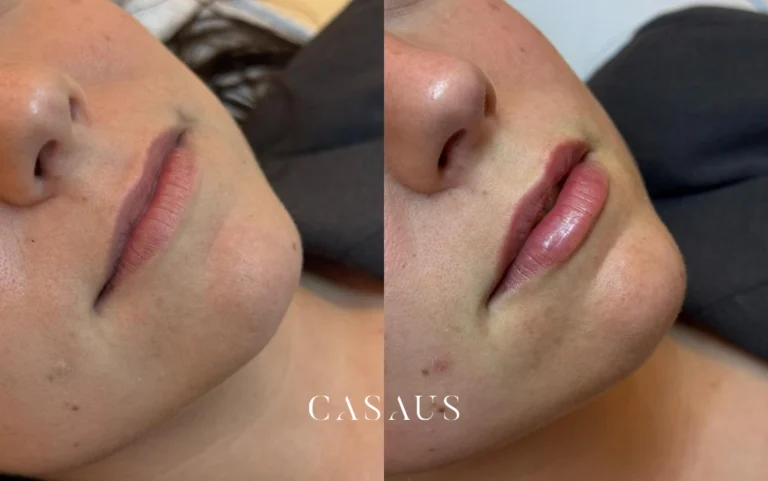 casos antes despues medicina estetica casaus el prat de llobregat (8)