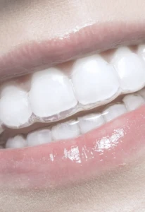 clinica-dental-casaus-ortodoncia-invisible