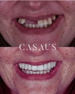 protesis sobre implantes casaus el prat de llobregat (1)